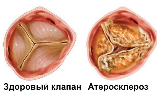 Стеноз аортального клапана противопоказания thumbnail