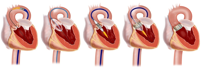 Стеноз аортального клапана противопоказания